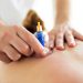 Medicupping Massage
